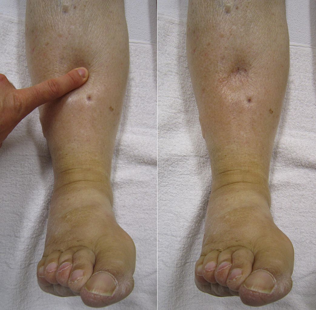 What Are Leg Discoloration and Leg Swelling?