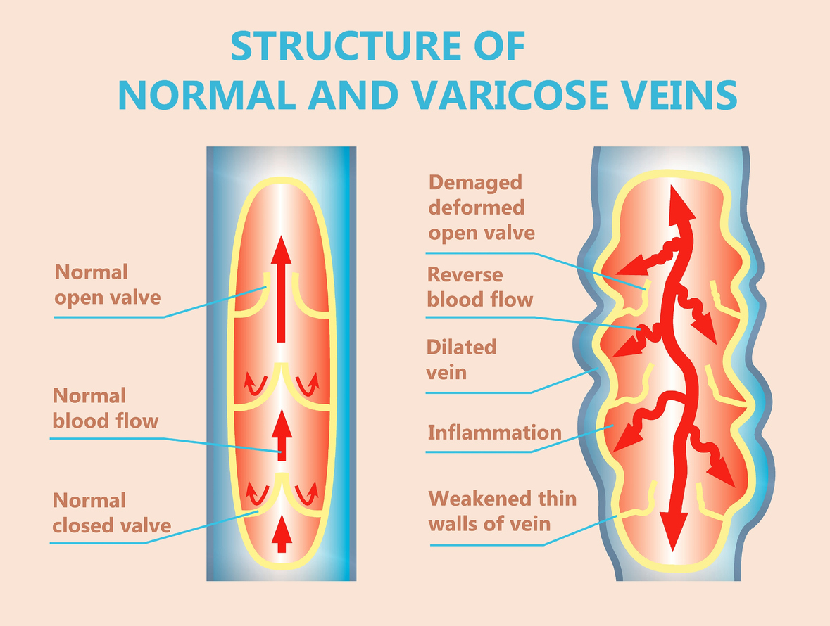 "varicose-veins-chart-venous-reflux-disease"