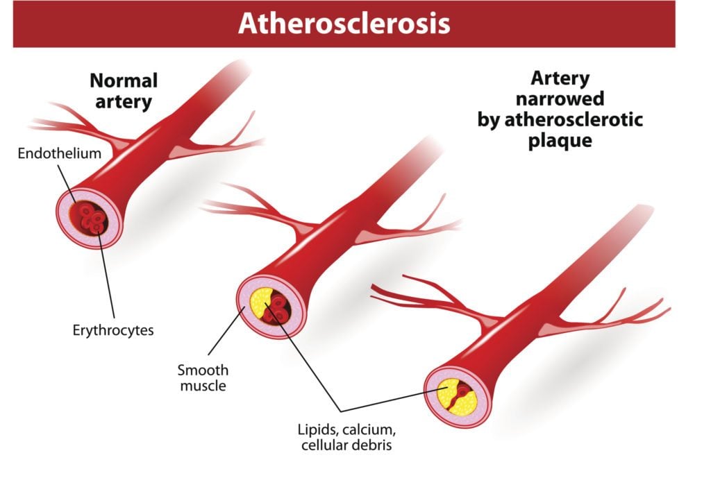 Claudication Treatment Annapolis 