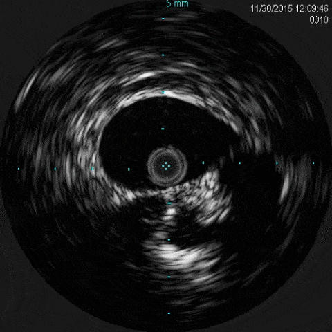 IVUS Examination | Intravascular Ultrasound Diagnosis Center
