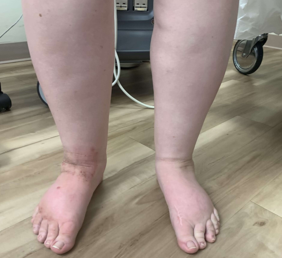 "Leg-Swelling-Treatment-Before"
