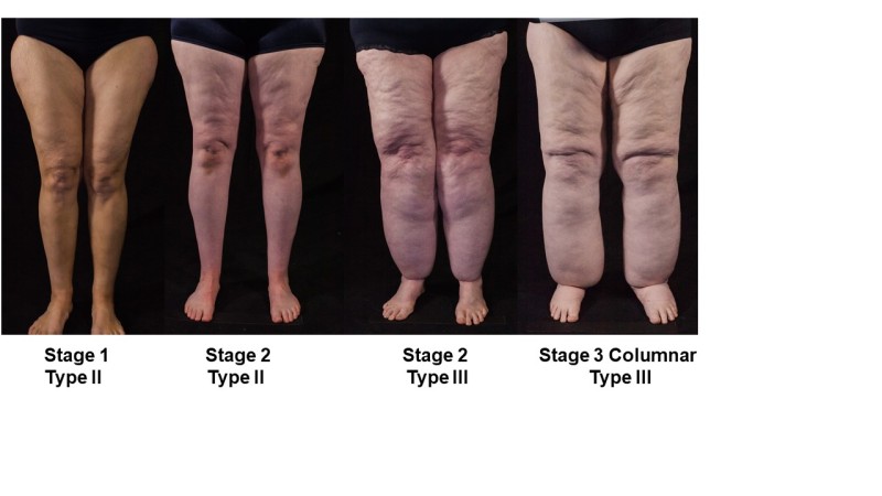 TENGO LIPEDEMA. ¿QUÉ MEDIAS DEBO - clinicaconstanza