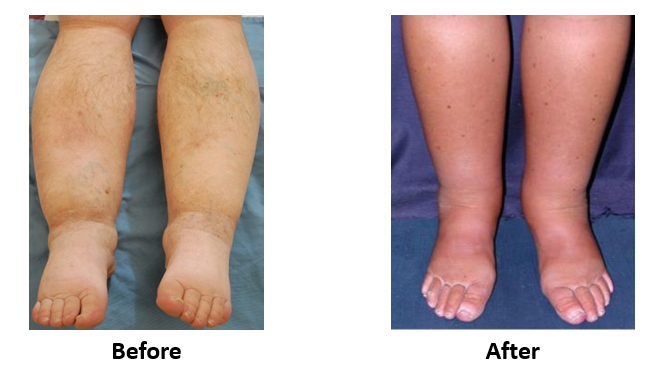 Leg Edema & Swelling Treatment | Vascular Doctor Maryland