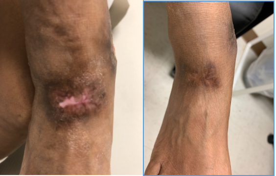 leg-ulcer-treatment-dr-Lakhanpal