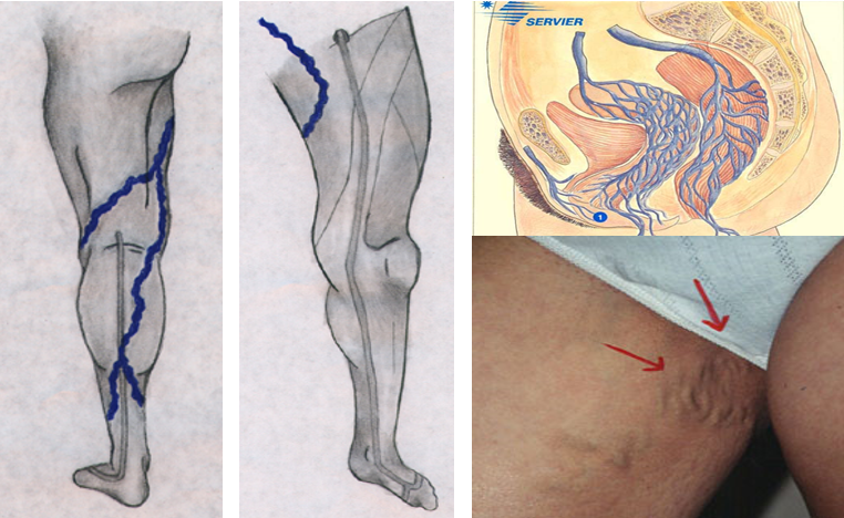 Humo Miguel Ángel pedazo Son las Varices Pélvicas una Señal de Advertencia de una Afección Vascular?  | Center for Vascular Medicine