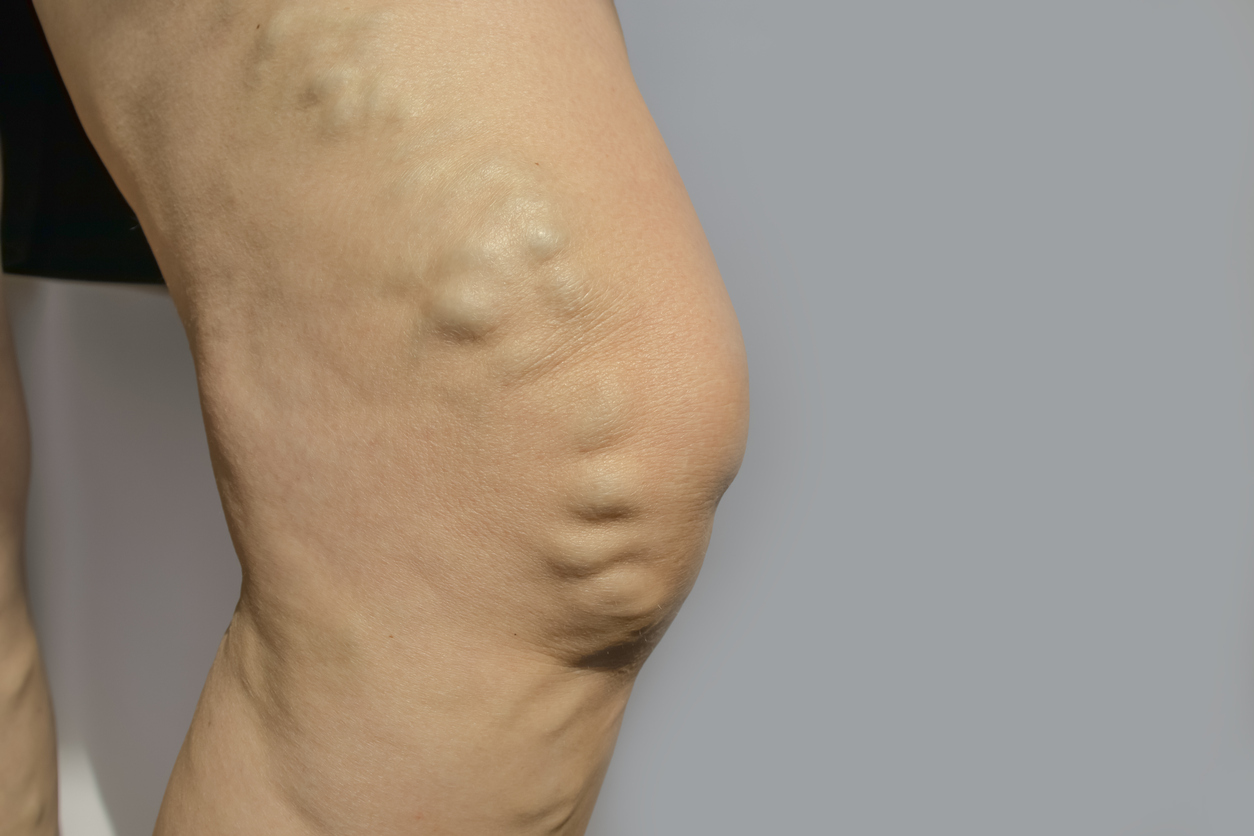 vulvar-varicosities-pelvic-pain-veins-on-legs