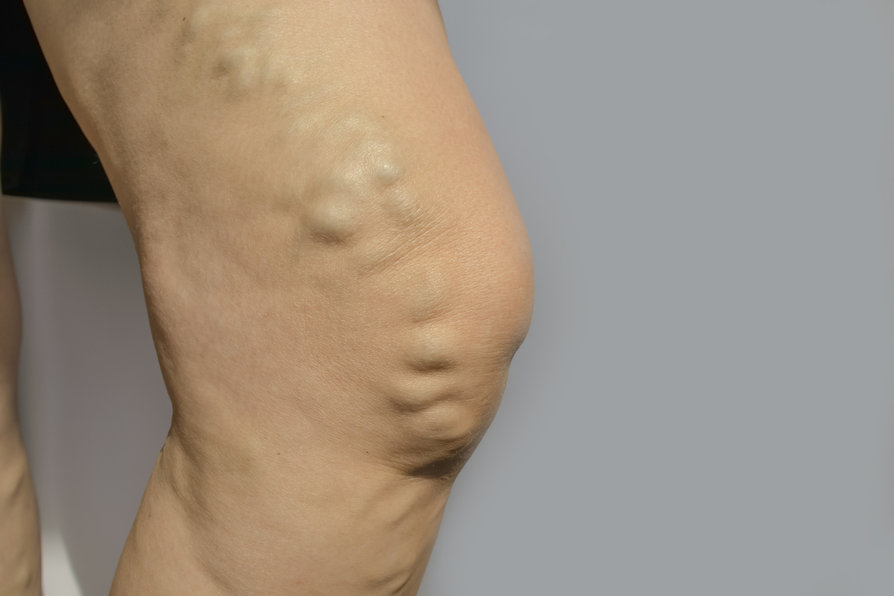 Varicose Veins Vulva 