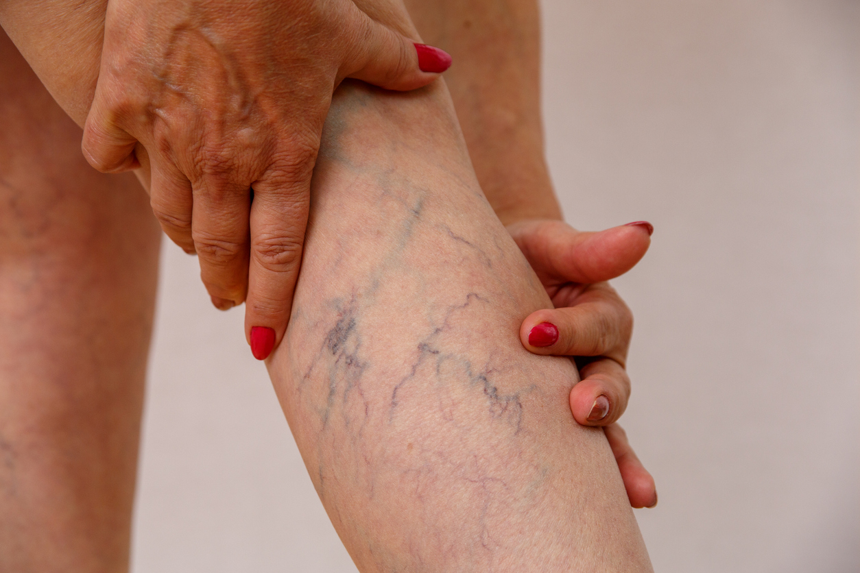 leg-pain-female-varicose-veins-spider-vein