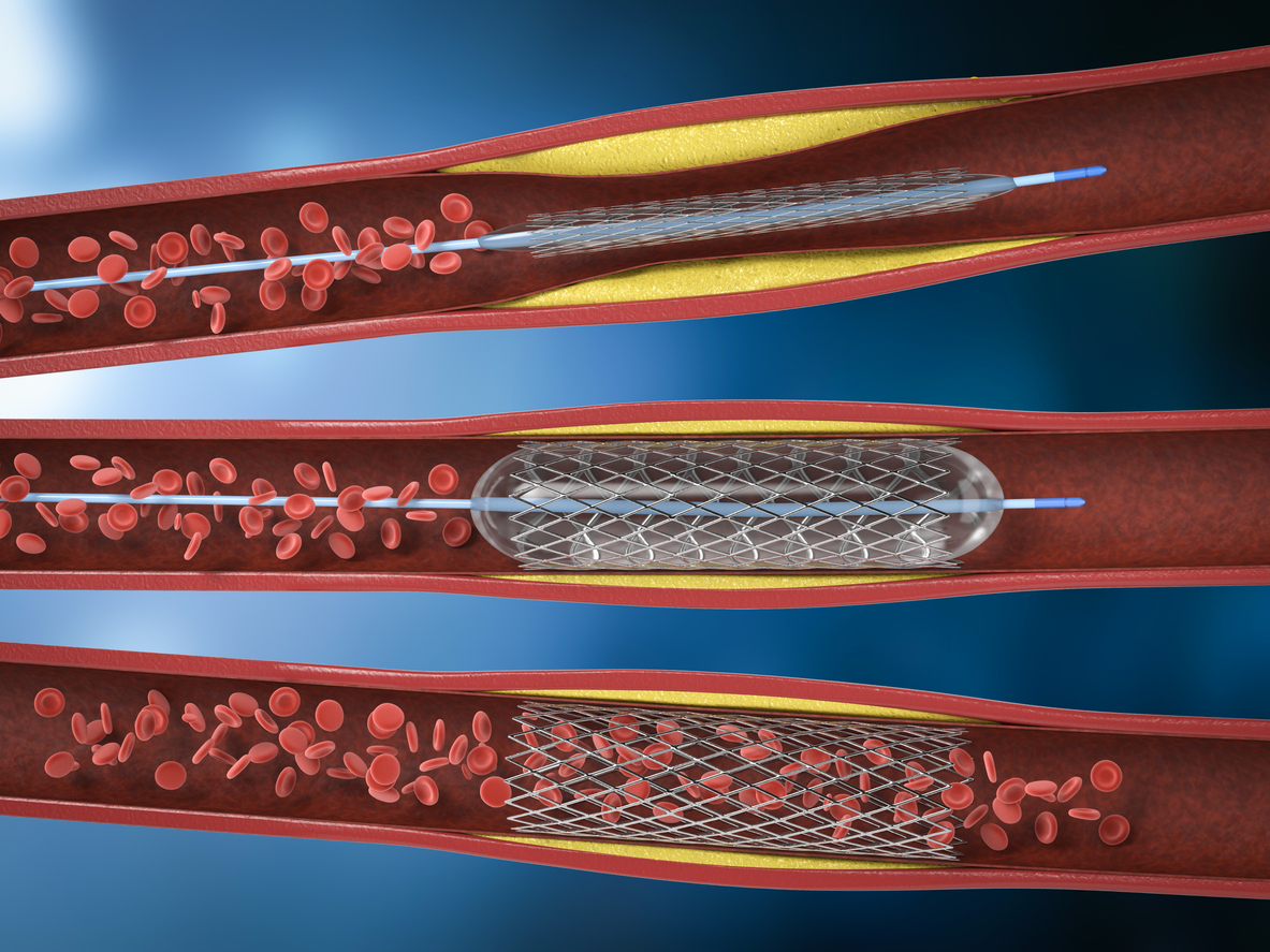 How-PAD-is-Treated-Image-Stent-Angioplasty-Angiogram