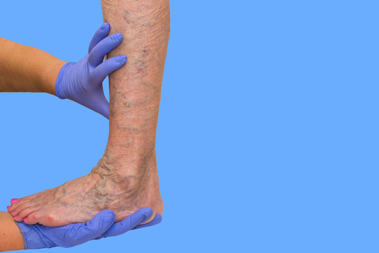 venous-insufficiency-in-legs-man-varicose-veins