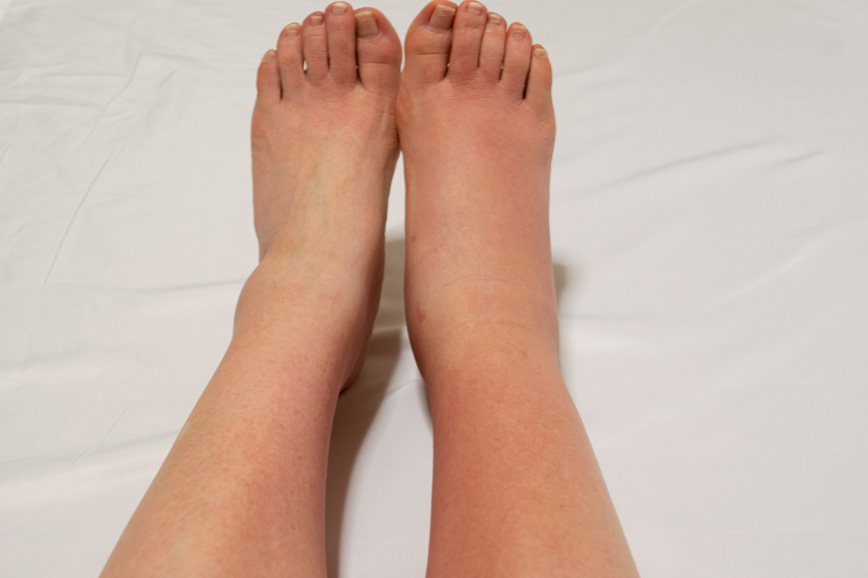 What to do for Prolonged Swelling in the Legs?