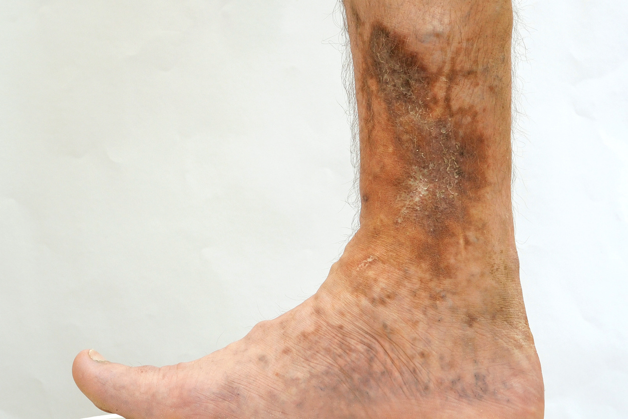 patient-leg-discoloration-from-venous-disease