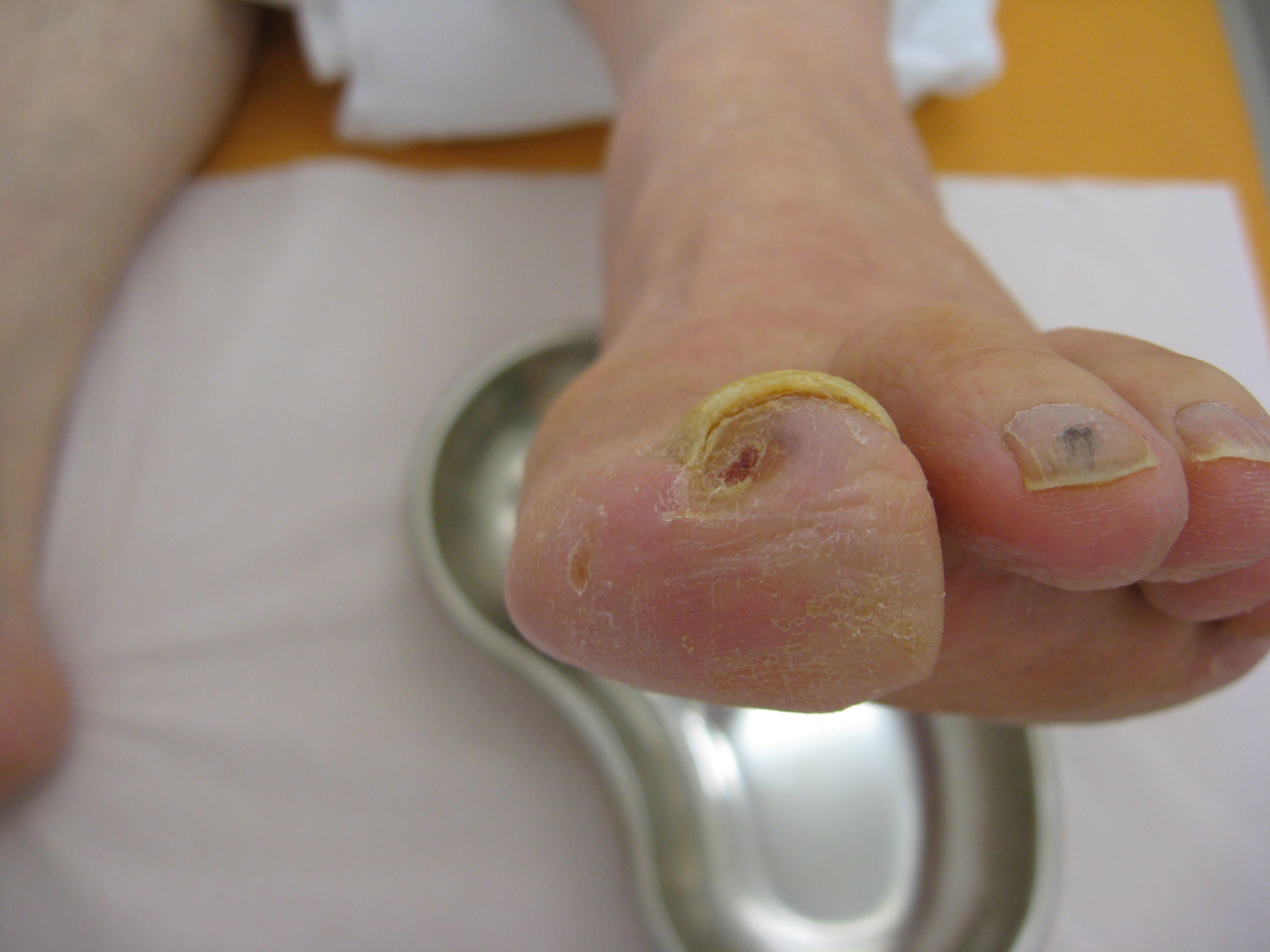 holes-toes-pad-arterial-disease-patient