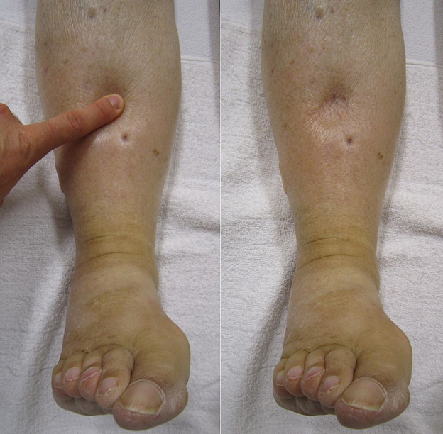 Leg Edema Swelling Treatment Vascular Doctor Maryland