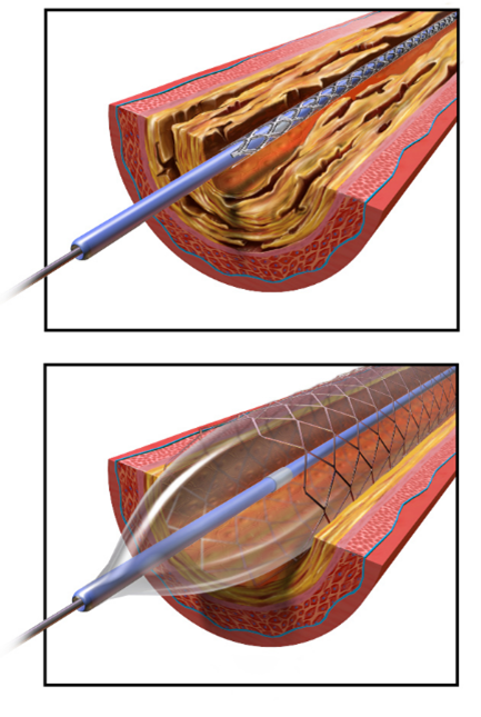 Angioplasty (Agp) is a minimally invasive procedure used to widen narrowed or blocked coronary arteries, improving blood flow to the heart. It involves using a balloon catheter to compress plaque against the artery walls, thereby restoring blood flow.