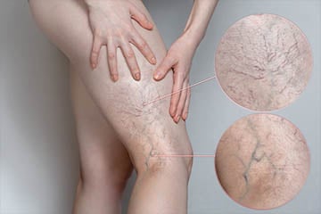 Deep vein thrombosis should be handled by a vascular physician