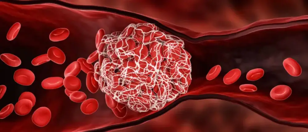 Blood Clot Treatment and Causes