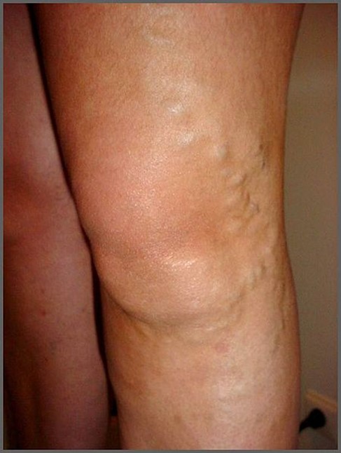 Chronic venous insufficiency