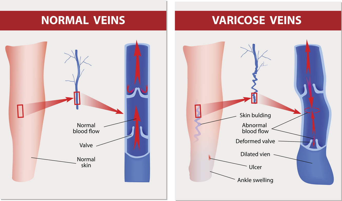 Venous Hypertension or Venous Insufficiency: What Is the Difference?