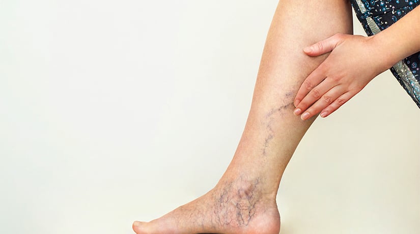 Pelvic Pain During or After Sex | May Thurner Syndrome Symptoms