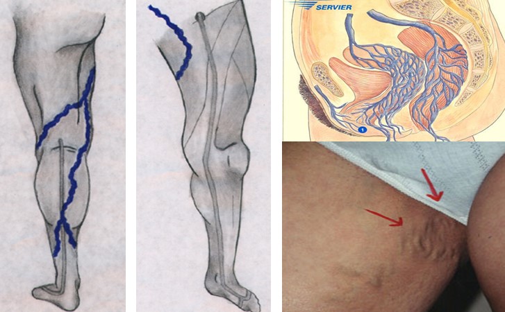 Flank pain radiating to the suprapubic region