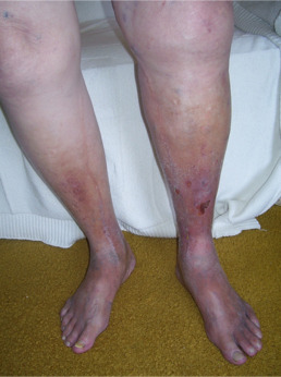 Post-thrombotic syndrome