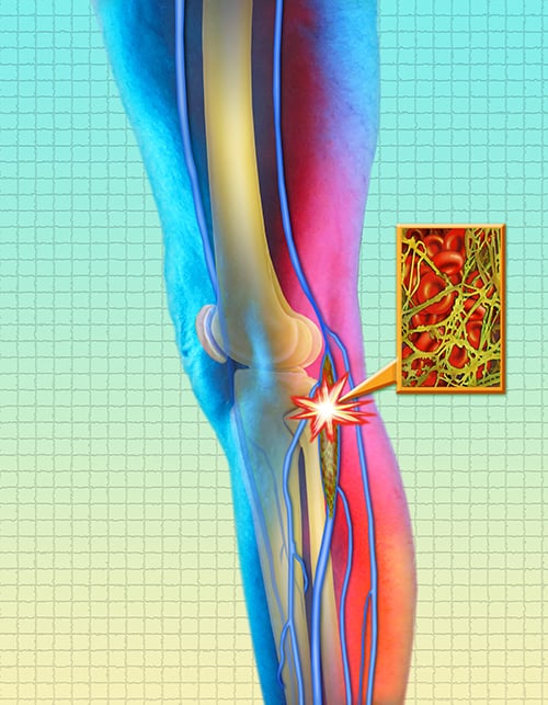 Diagram of leg showing leg ulcer