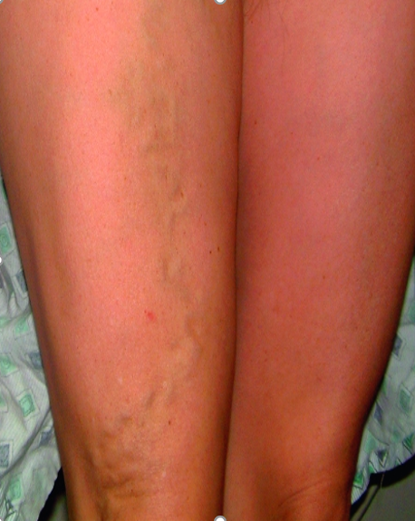 "varicose-vein-thigh-region-warning-sign-pelvic-pain-vascular"