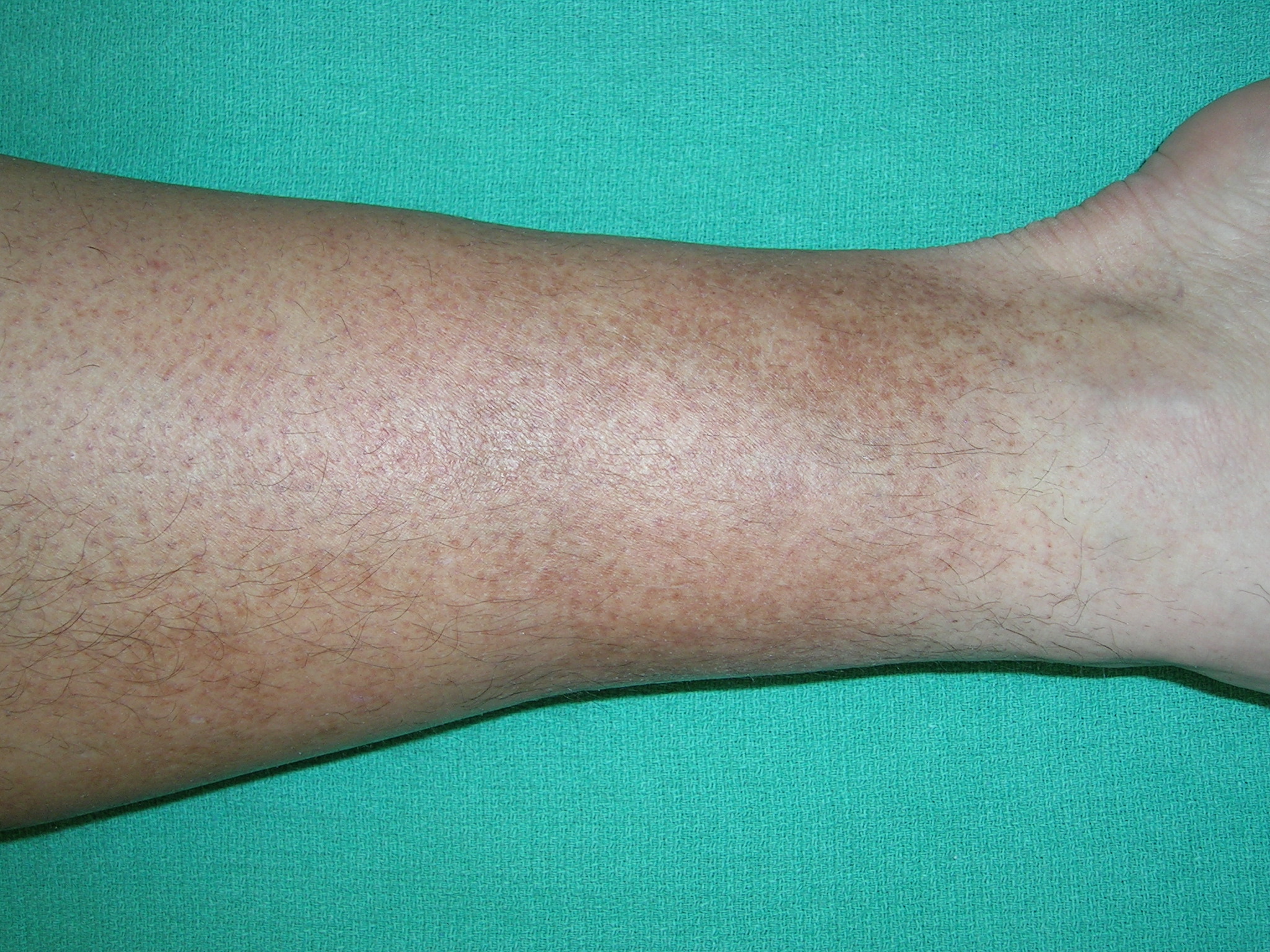 Leg Discoloration Treatment and Causes